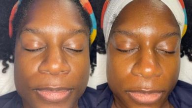 Why Choose Queen Aesthetics for Your Chemical Peel in Houston