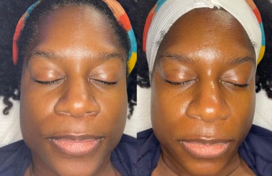 Why Choose Queen Aesthetics for Your Chemical Peel in Houston