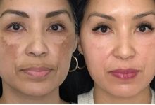 How Can Celibre Help with Age Spots Removal in Torrance