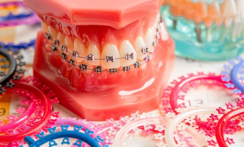 The Role of One Band Space Maintainers in Early Orthodontic Treatment