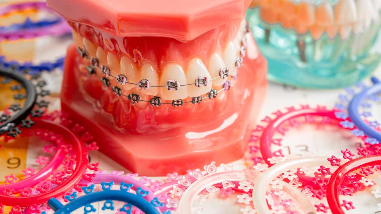 The Role of One Band Space Maintainers in Early Orthodontic Treatment