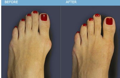 Where to Find Minimally Invasive Bunion Surgery Near Me