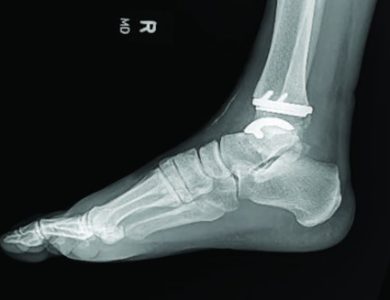 Where to Find the Best Star Total Ankle Replacement