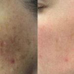 Why Celibre's Scar Removal Techniques Are Unparalleled in Torrance