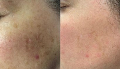 Why Celibre's Scar Removal Techniques Are Unparalleled in Torrance
