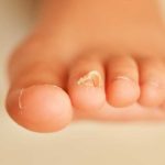 Where to Find Top Toe Nail Fungus Treatment in Arizona