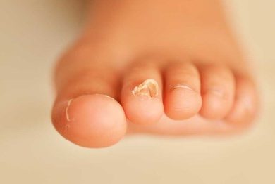 Where to Find Top Toe Nail Fungus Treatment in Arizona