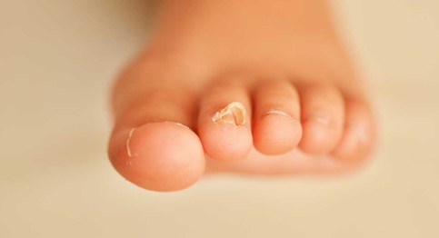 Where to Find Top Toe Nail Fungus Treatment in Arizona