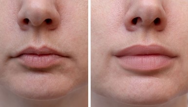 How to Choose the Best Lip Filler Clinic in Kansas City