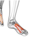 Where to Get Metatarsal ORIF in Arizona