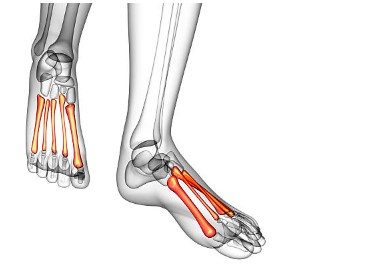 Where to Get Metatarsal ORIF in Arizona