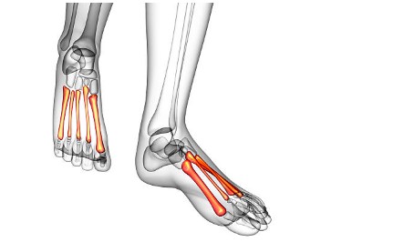 Where to Get Metatarsal ORIF in Arizona