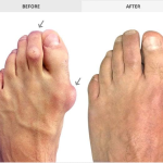 How Long Does It Take to Recover from Bunion Surgery