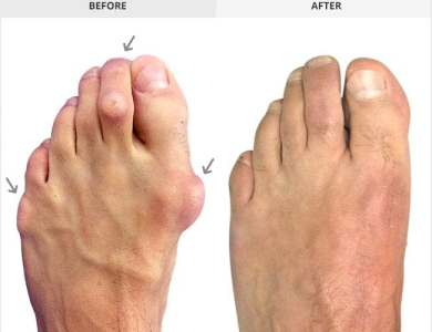 How Long Does It Take to Recover from Bunion Surgery