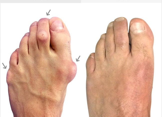 How Long Does It Take to Recover from Bunion Surgery