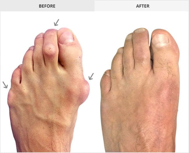 How Long Does It Take to Recover from Bunion Surgery